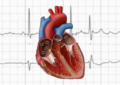 Effective Nursing Interventions for Atrial Fibrillation