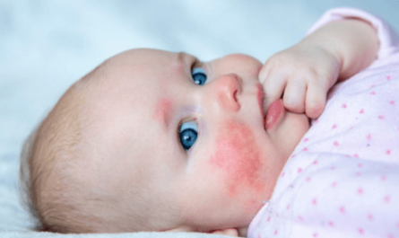 Milk Allergy and Baby Rash on Face - A Comprehensive Guide