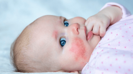 Milk Allergy and Baby Rash on Face – A Comprehensive Guide