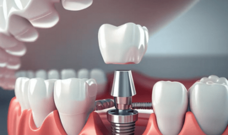 dental implants