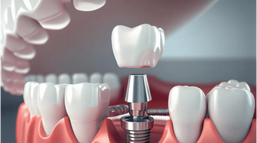 Precision and Perfection – Advanced Dental Treatments for a Flawless Smile