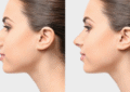 Rhinoplasty in Bangalore