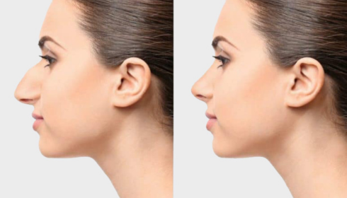 Transform Your Appearance with Expert Rhinoplasty in Bangalore