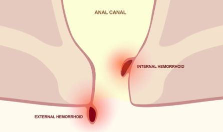 what is a hemorrhoid