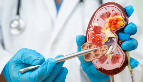 Discovering the Best Kidney Transplant Hospital in Bangalore: A Guide to World-Class Care